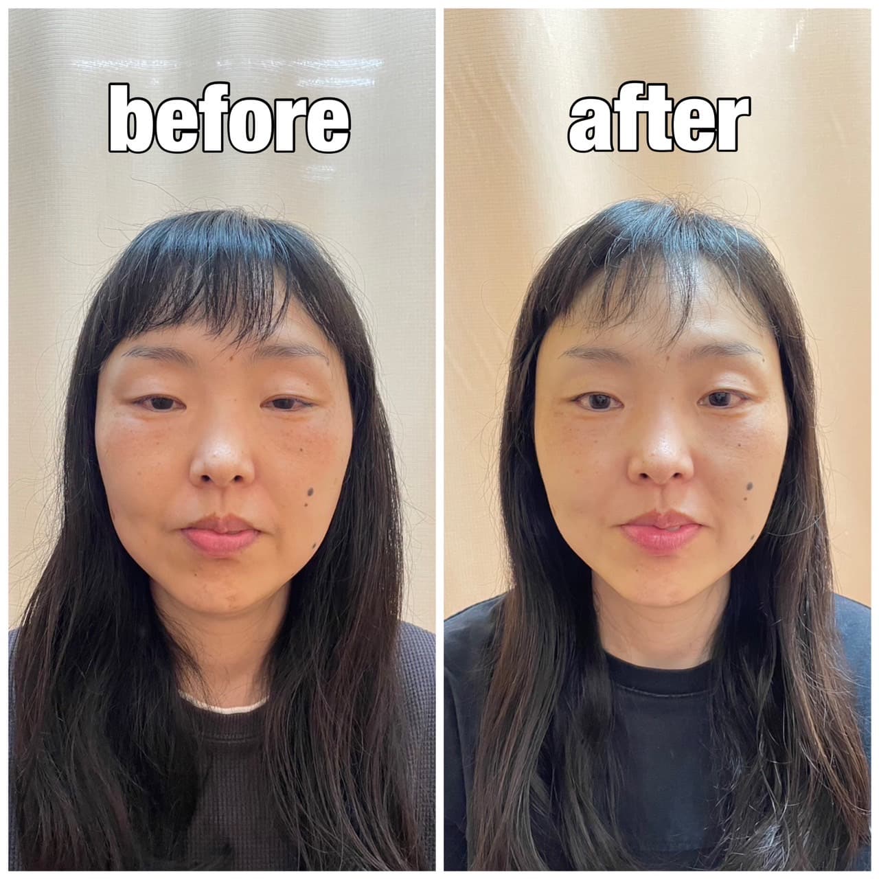 瞼がスッキリして表情も明るくなりました!