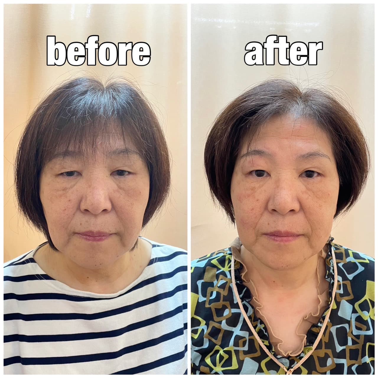 頬がリフトアップ、ほうれい線も薄く