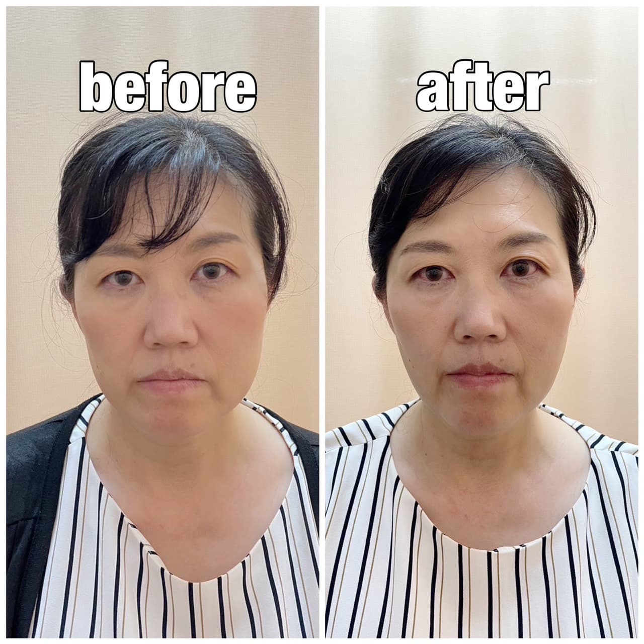 頬がすっきり引き締まりました!